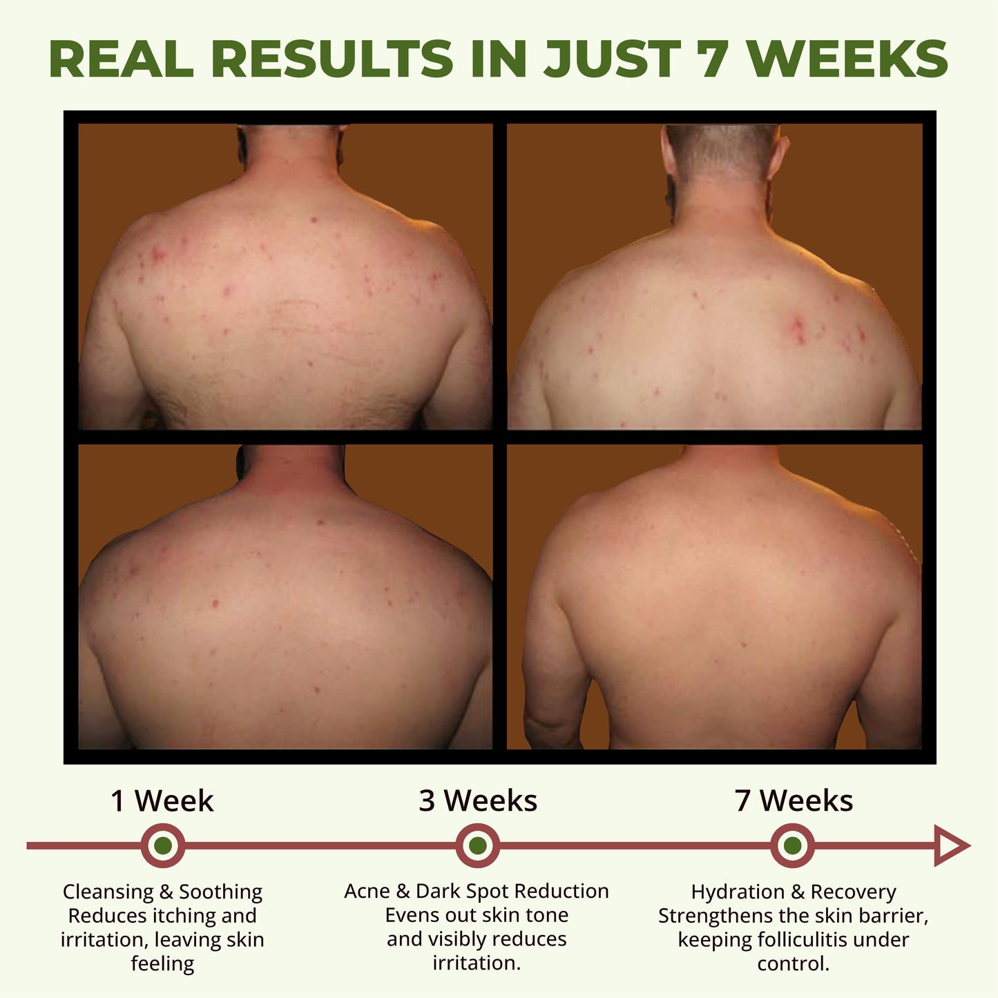 ABERA Folliculitis, BHA Shower Gel, High-Performance Folliculitis Body Wash, Wild Bitter Melon Extract