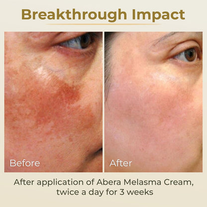 Abera Melasma Cream Premium | Advanced Dark Spot Corrector for Melasma, Freckles & Sun Spots