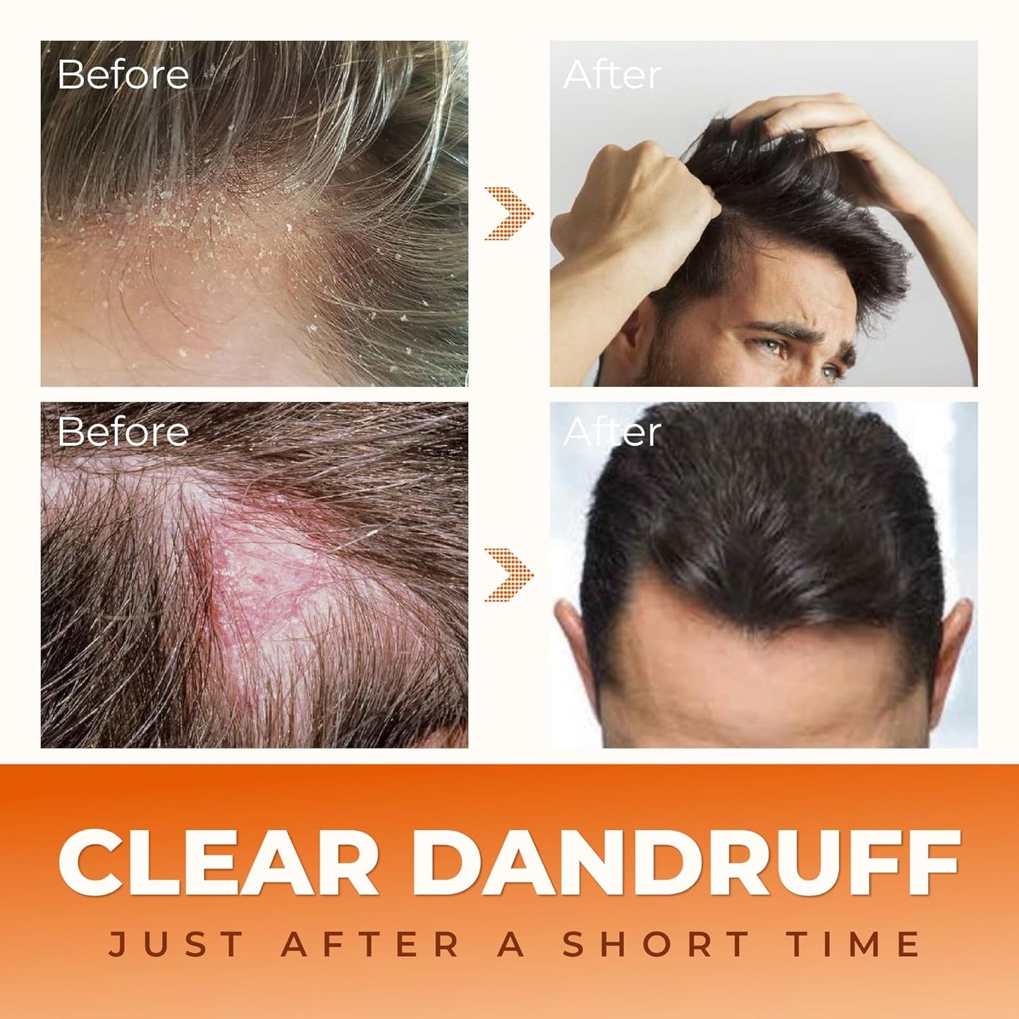 Abera Anti-Dandruff Shampoo | Nourishing Formula for Healthy Scalp & Stronger Hair Growth