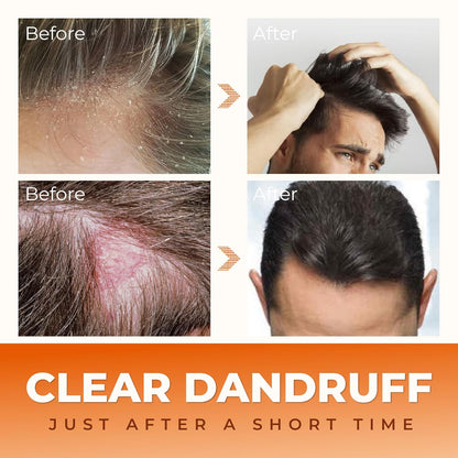 Abera Anti-Dandruff Shampoo | Nourishing Formula for Healthy Scalp & Stronger Hair Growth