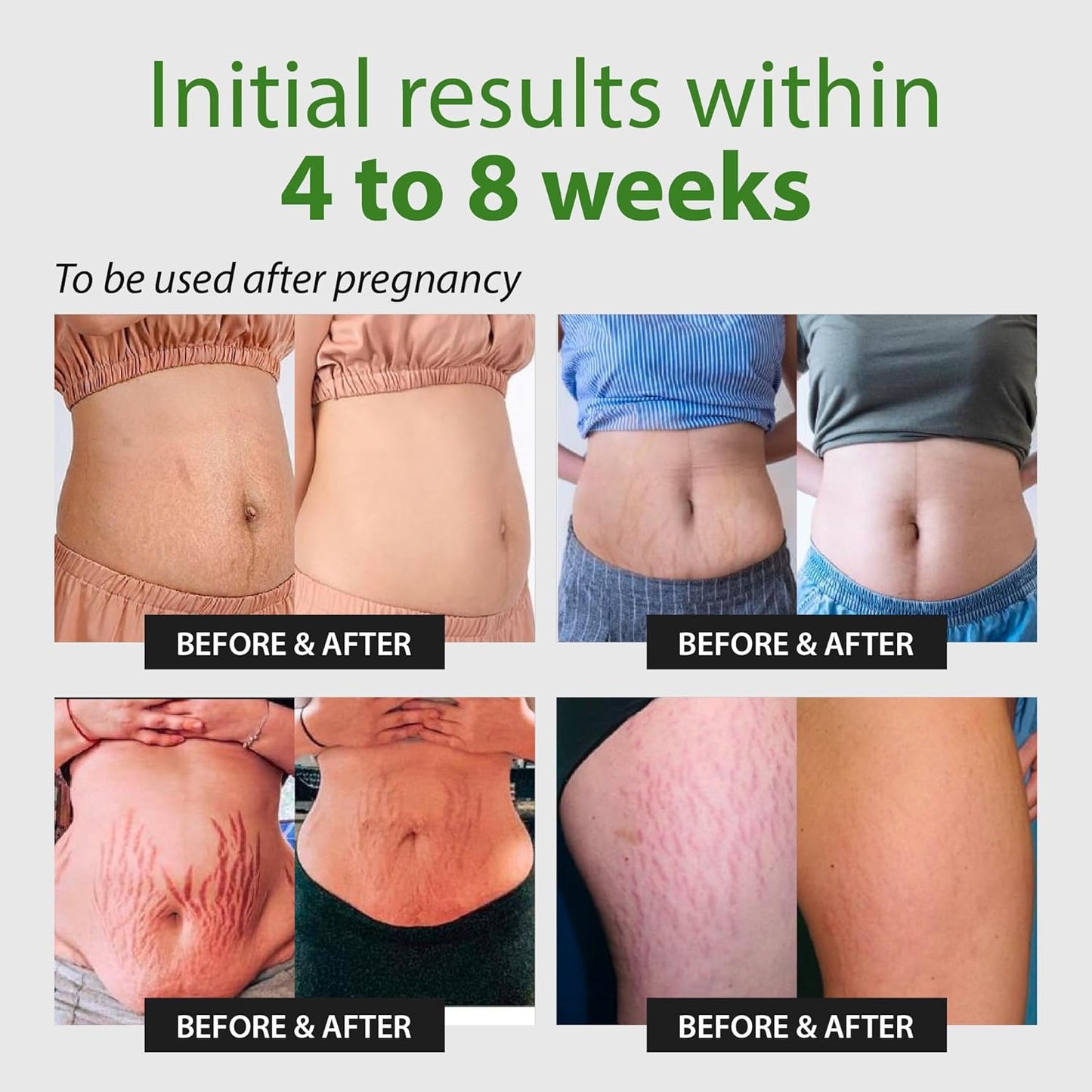 Abera Maternity Stretch Mark Cream | Pregnancy & Weight Change Care for Smooth Skin