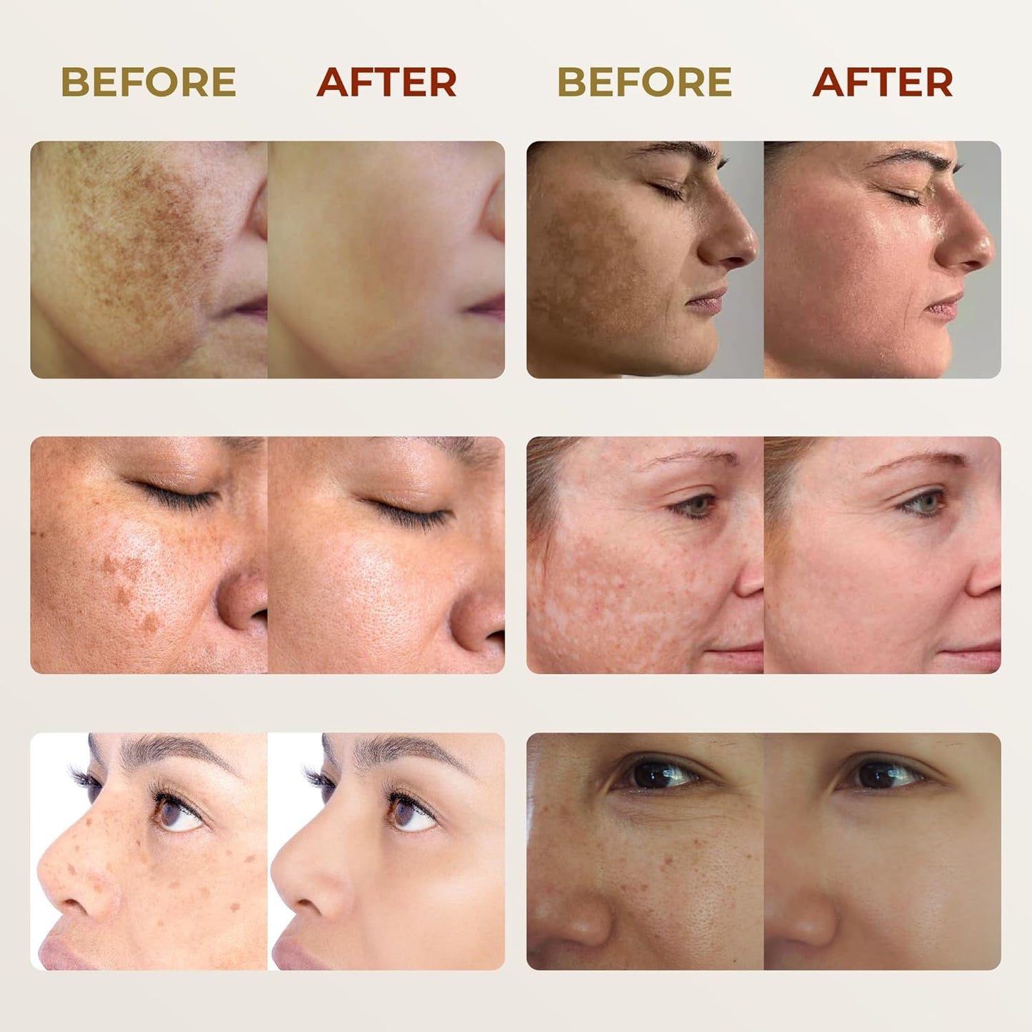 Abera Melasma Cream Premium | Advanced Dark Spot Corrector for Melasma, Freckles & Sun Spots
