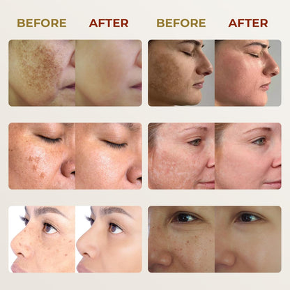 Abera Melasma Cream Premium | Advanced Dark Spot Corrector for Melasma, Freckles & Sun Spots