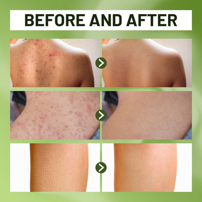 ABERA Folliculitis, BHA Shower Gel, High-Performance Folliculitis Body Wash, Wild Bitter Melon Extract