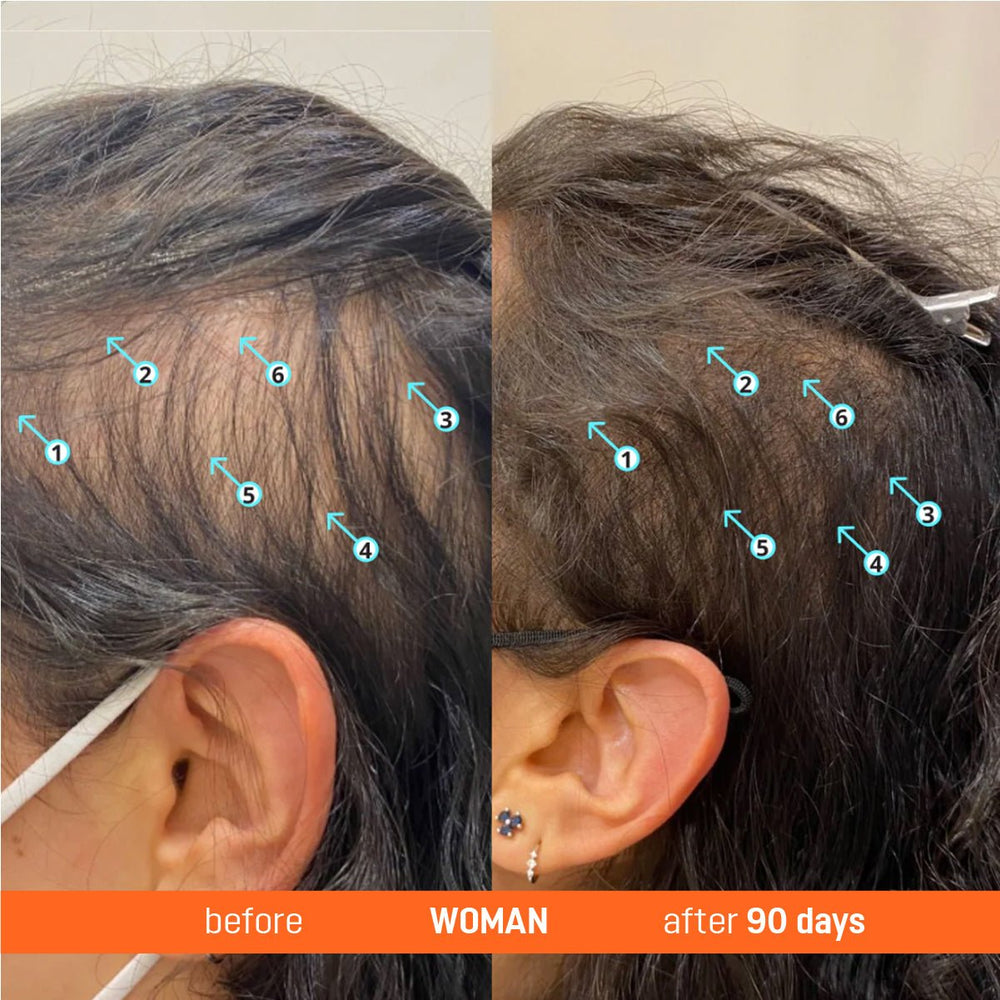 Abera Hair Serum with Redensyl — 3 Month Supply (3 Bottles) + Free Gold Scalp Roller