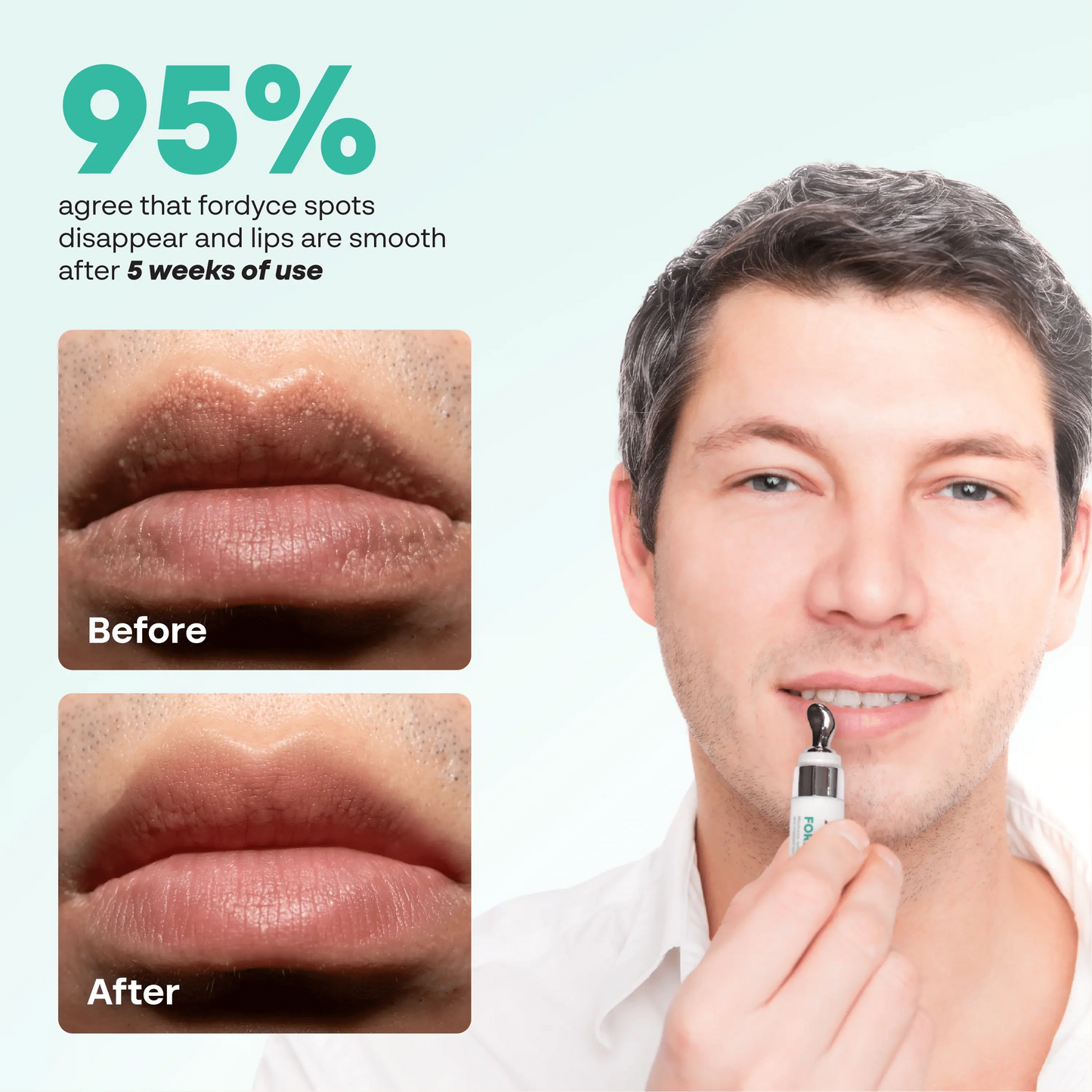 Abera Fordyce Cream | HPR Retinoid Formula for Fordyce Spots, Lip Acne & Dark Lips Care