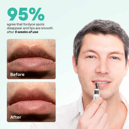 Abera Fordyce Cream | HPR Retinoid Formula for Fordyce Spots, Lip Acne & Dark Lips Care