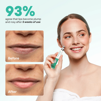 Abera Fordyce Cream | HPR Retinoid Formula for Fordyce Spots, Lip Acne & Dark Lips Care