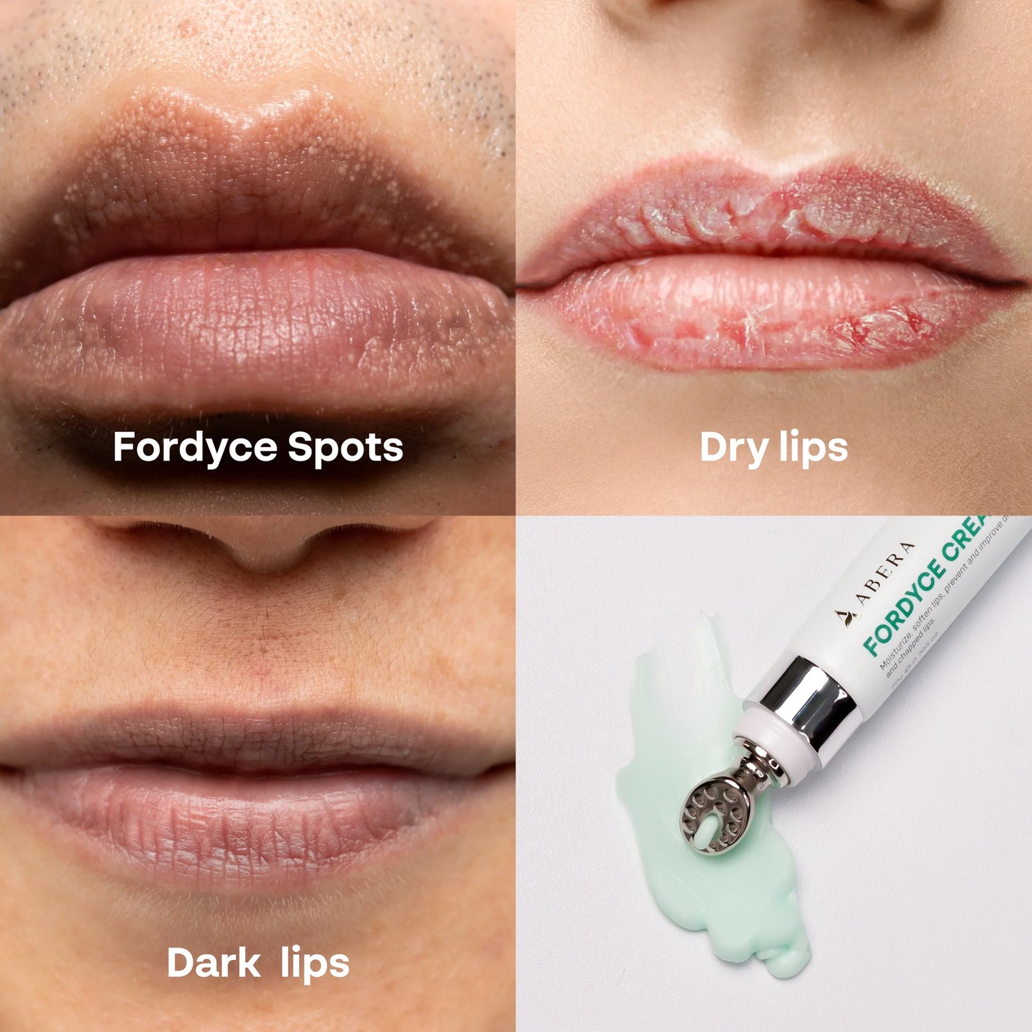 Abera Fordyce Cream | HPR Retinoid Formula for Fordyce Spots, Lip Acne & Dark Lips Care