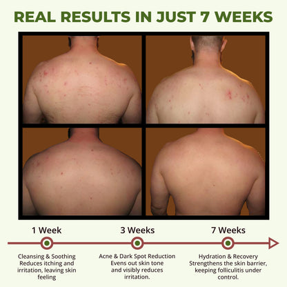ABERA Folliculitis, BHA Shower Gel, High-Performance Folliculitis Body Wash, Wild Bitter Melon Extract