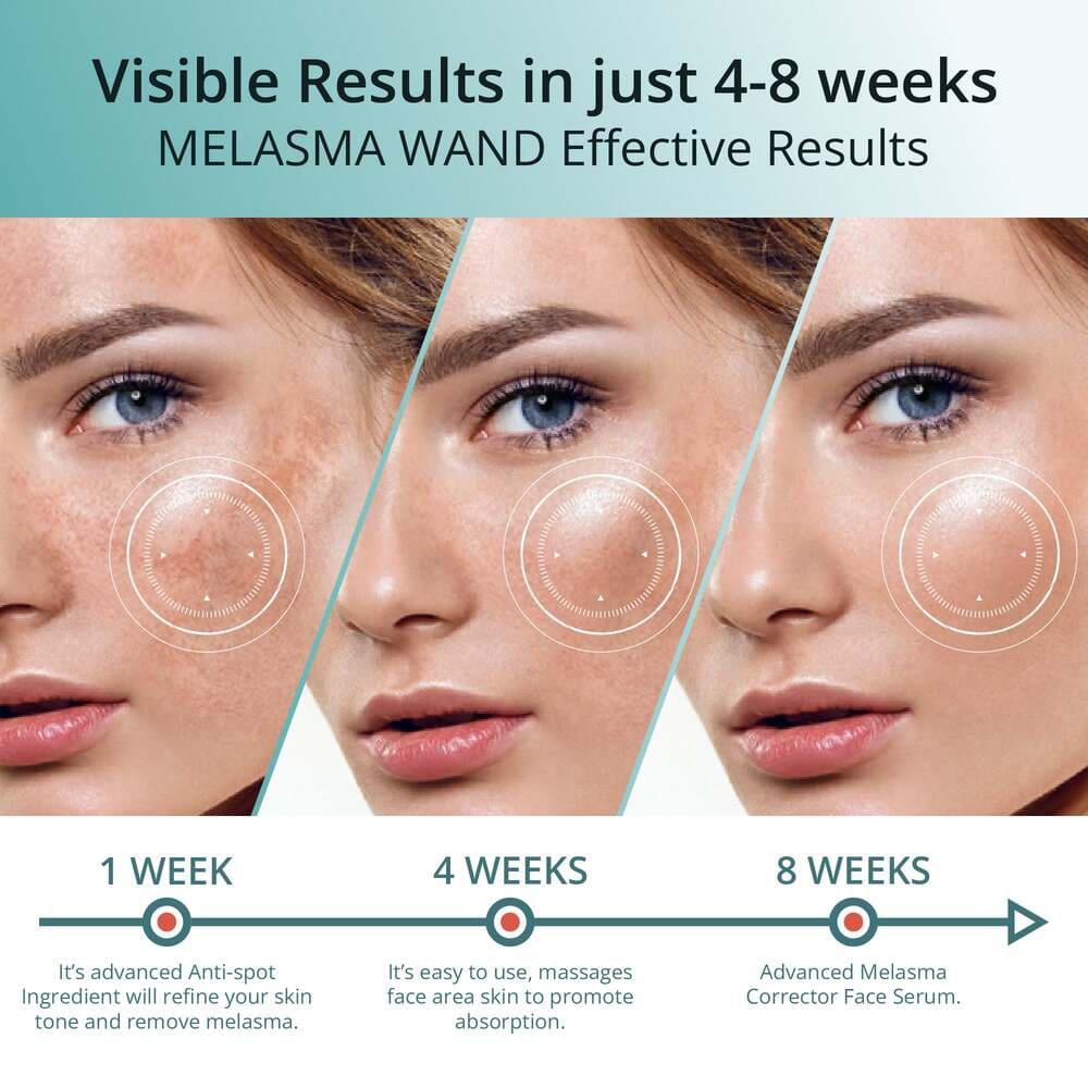 Abera Melasma Serum Plus, Advanced Dark Spot Corrector for Clear, Even, Radiant Skin